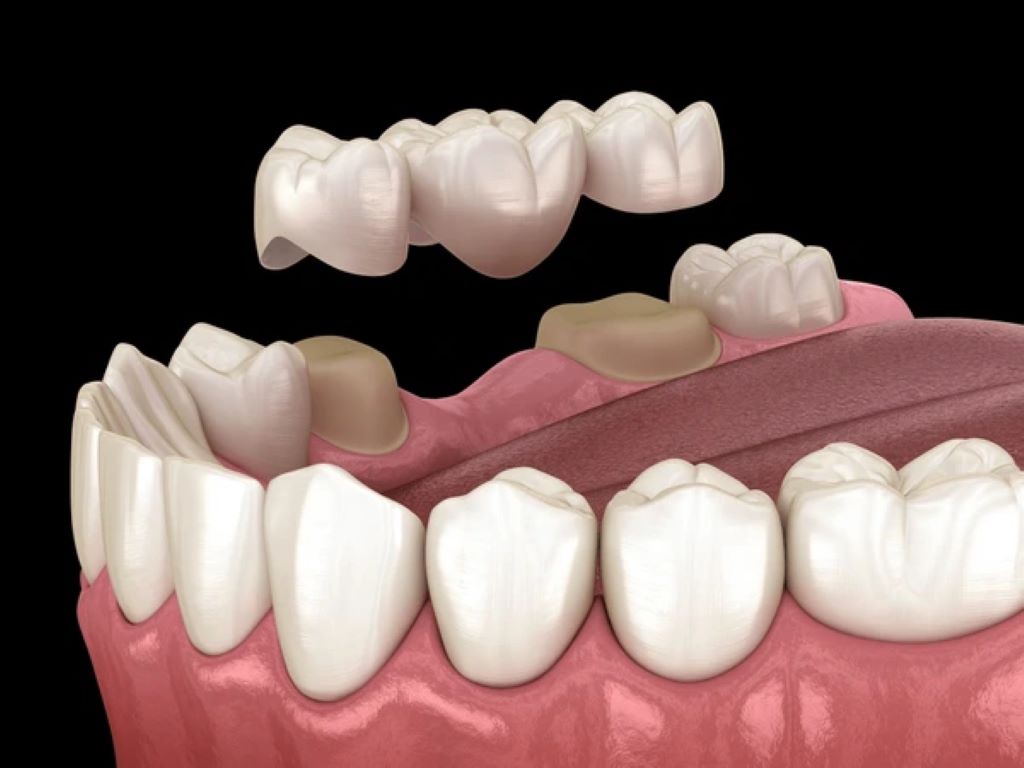 dental bridges in lake bonavista calgary