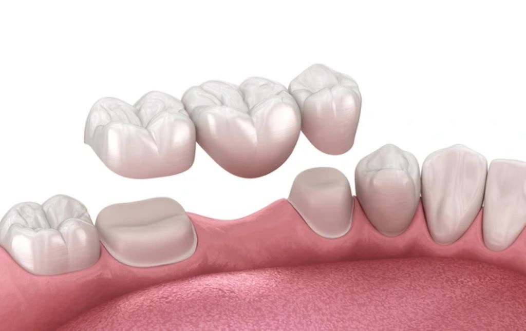 dental bridges near you