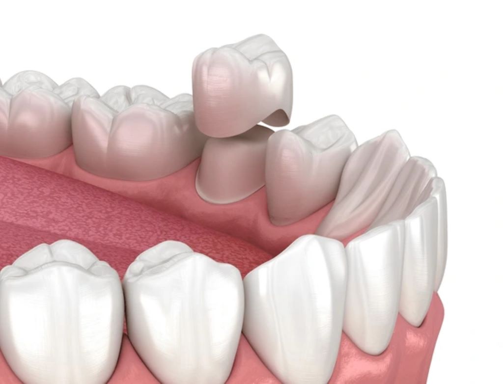 dental crowns in lake bonavista calgary