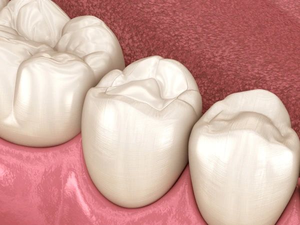 dental fillings in lake bonavista calgary
