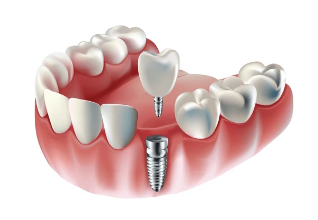dental implants in lake bonavista calgary