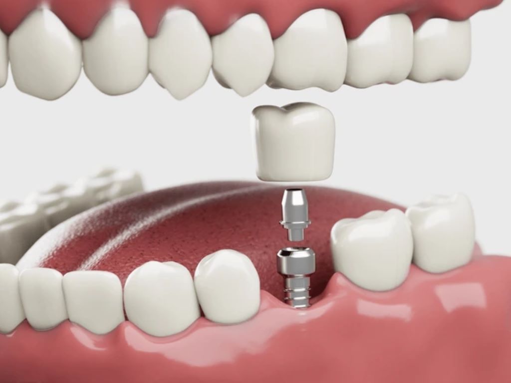 dental implants near you