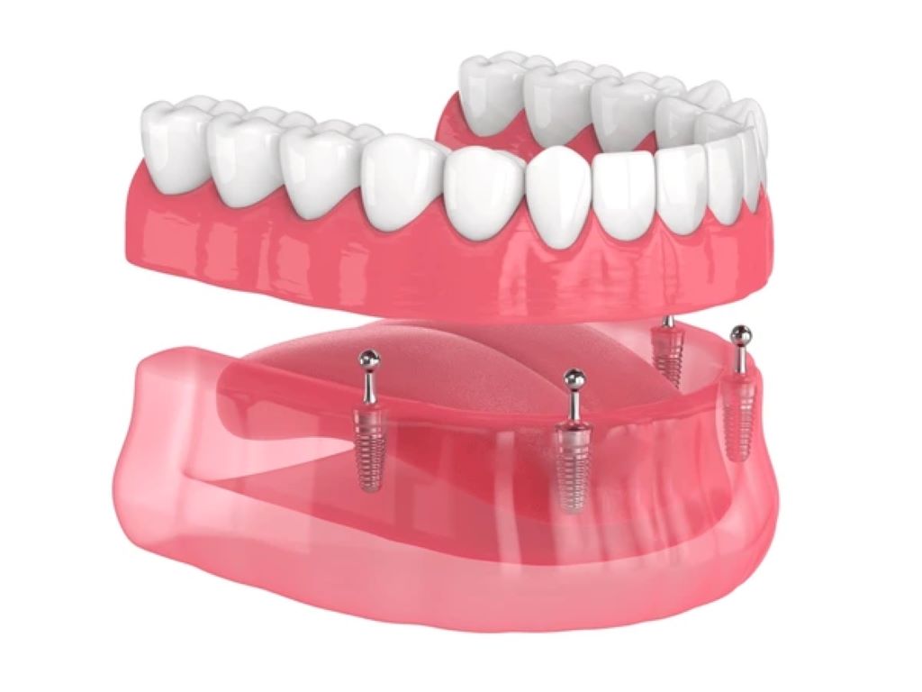 implant supported dentures in lake bonavista calgary