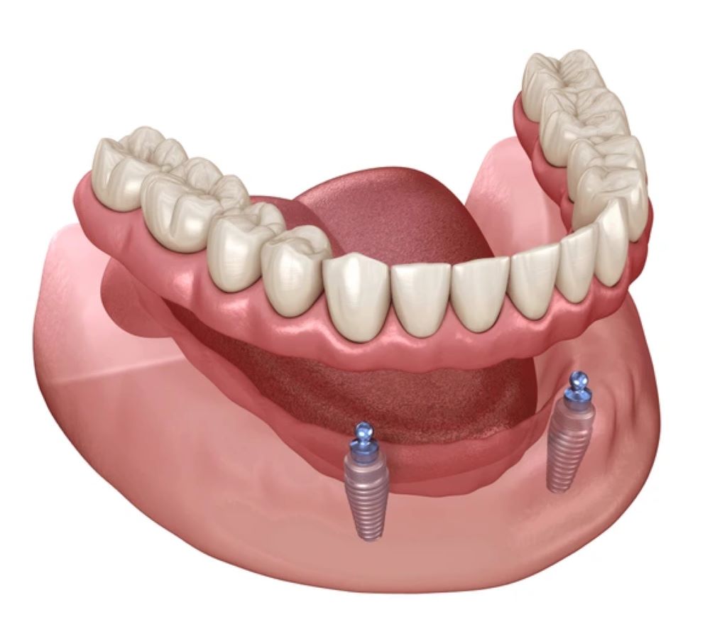 implant supported dentures near you