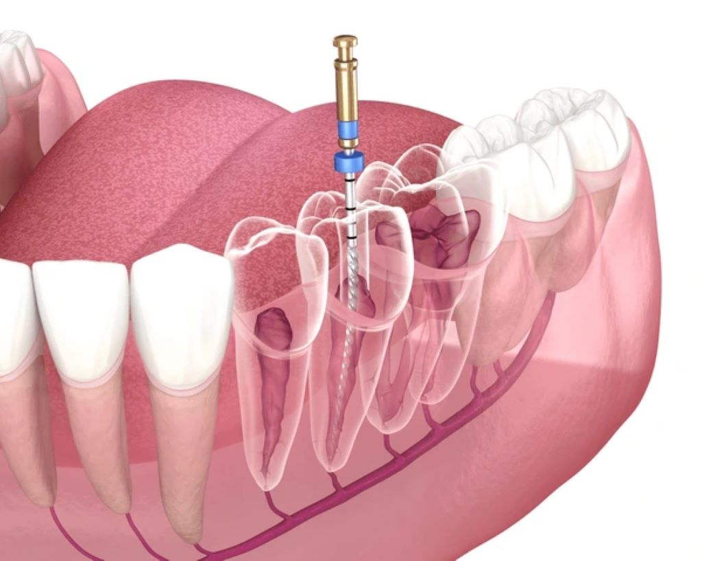 root canal therapy in lake bonavista calgary