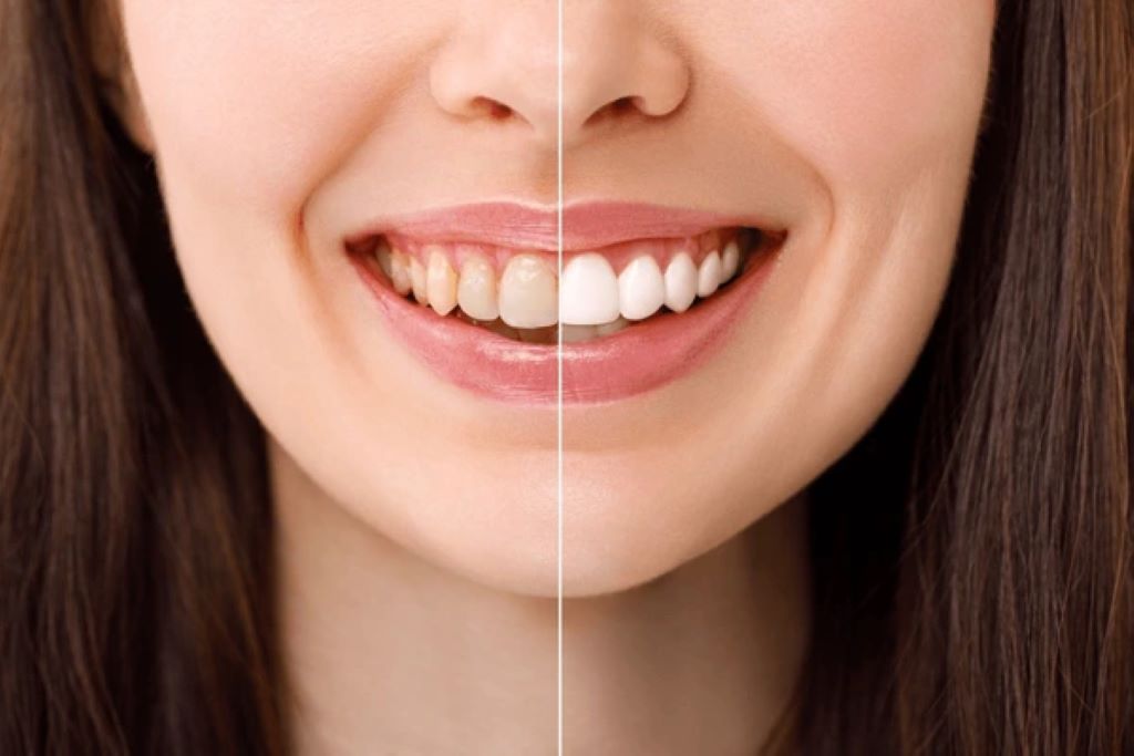 teeth whitening near you